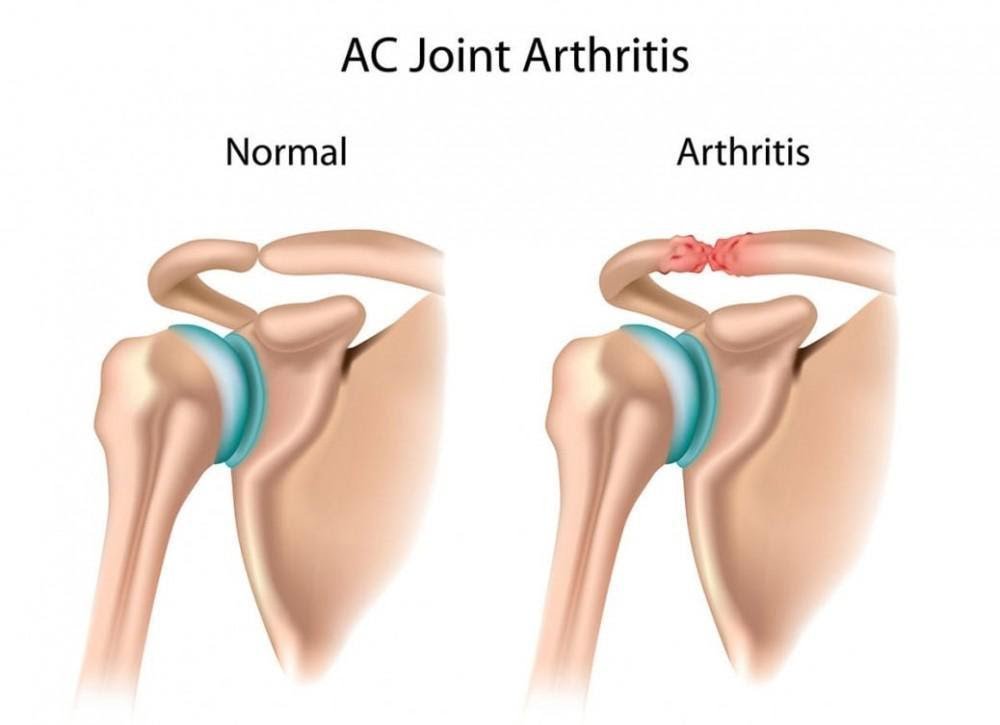 AC Joint Dislocation 02
