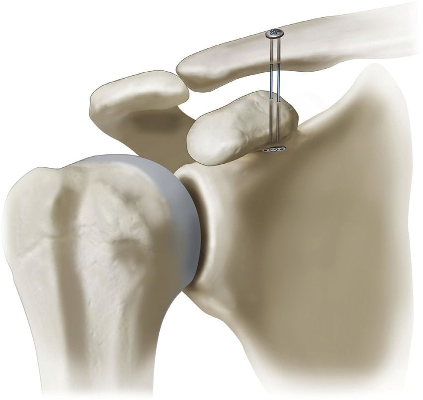 AC Joint Dislocation