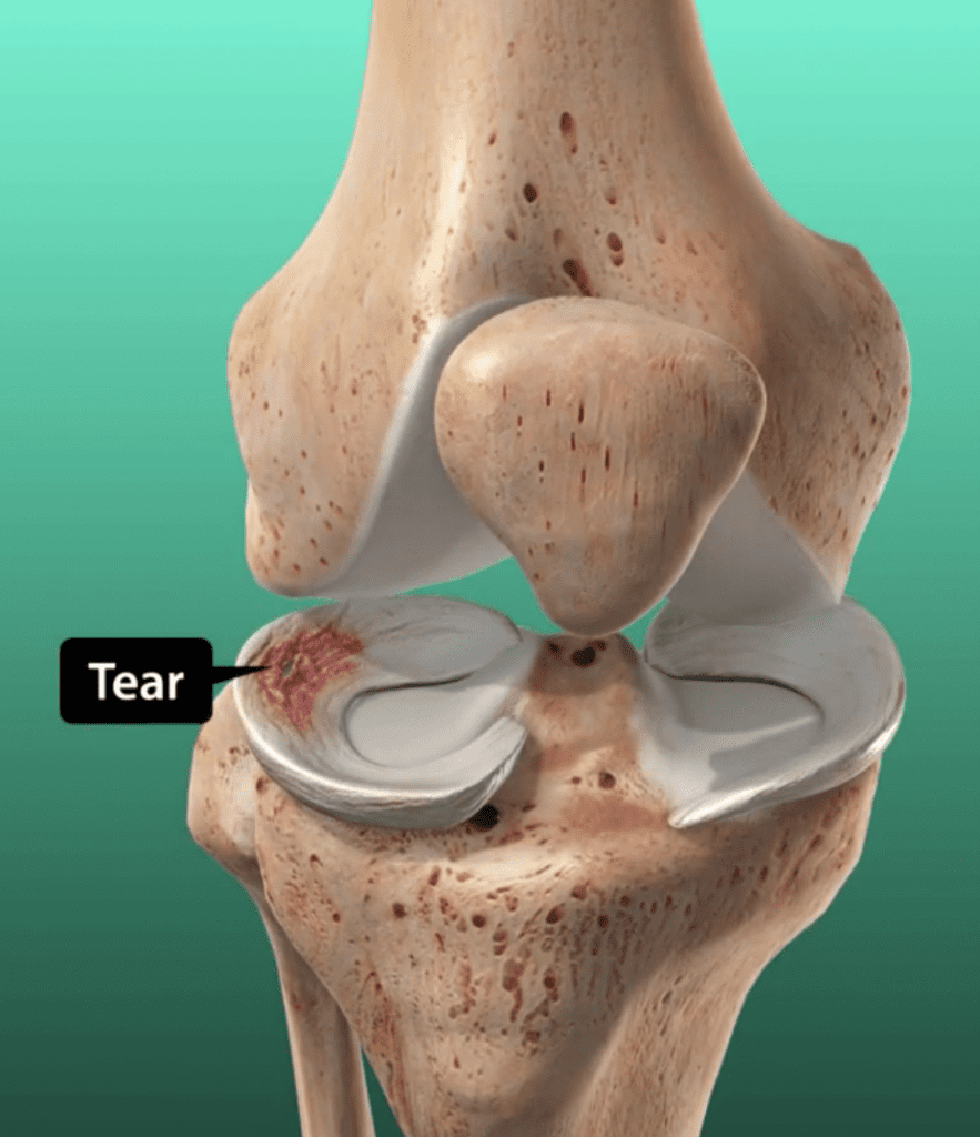 Meniscus Repair Surgery - Dr. Ishan Shevate