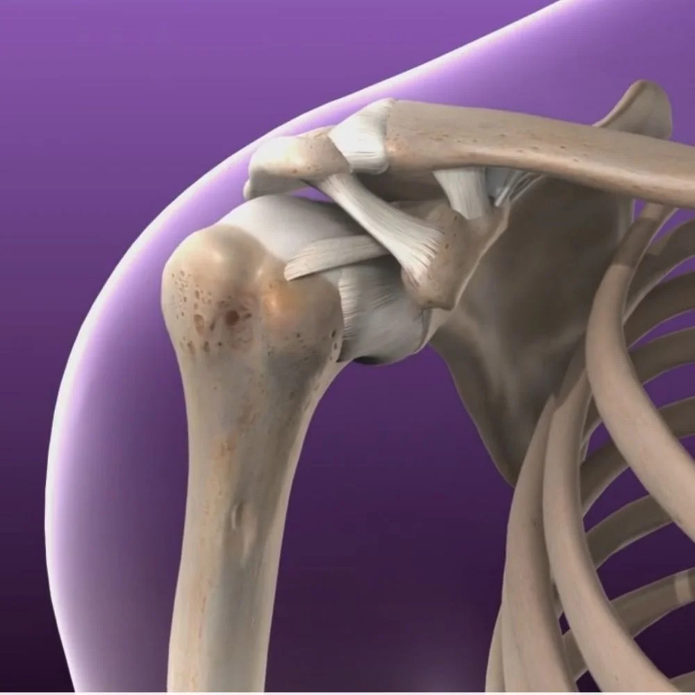 Recurrent Shoulder Dislocation Repair - Dr. Ishan Shevate