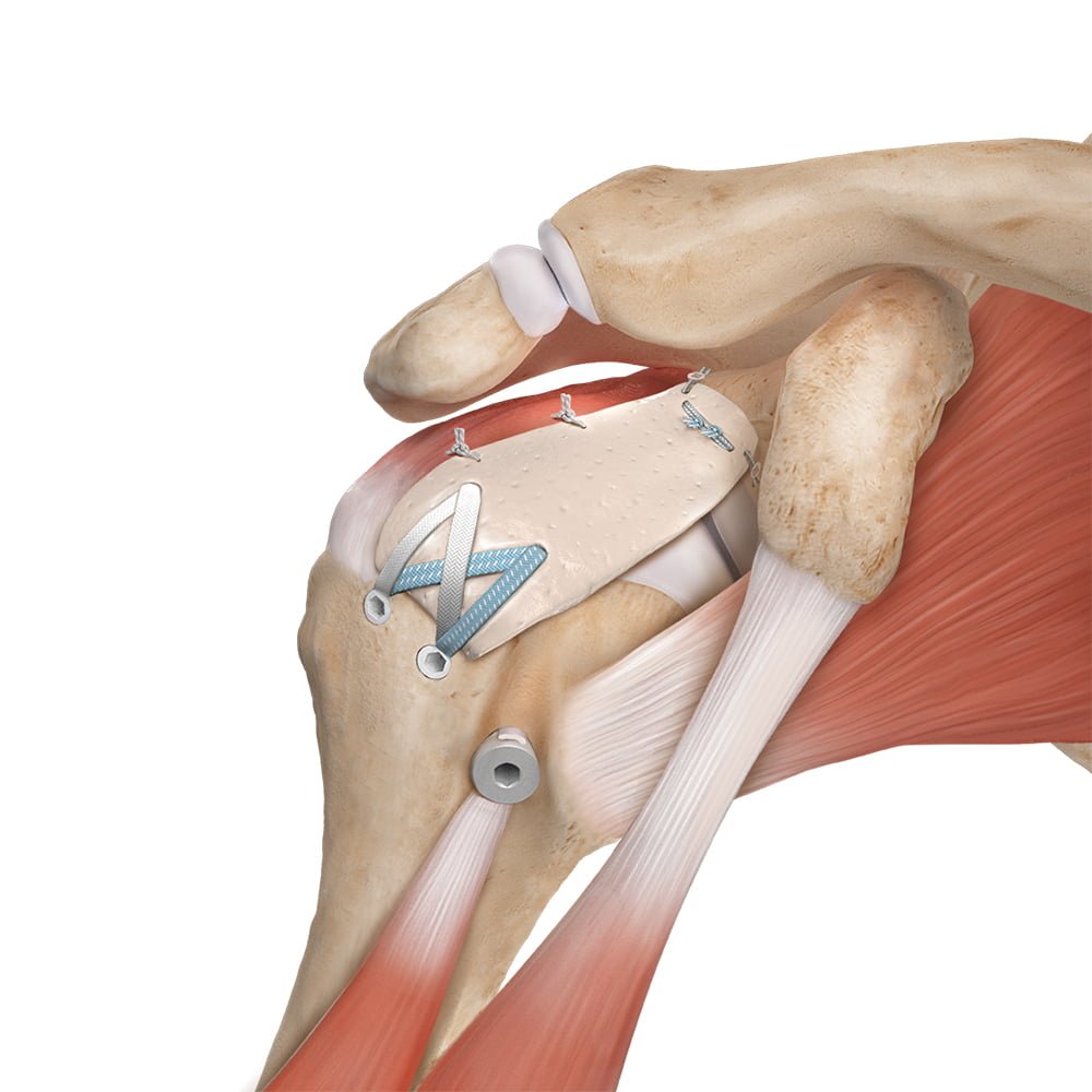 Rotator Cuff Tear Repair 1