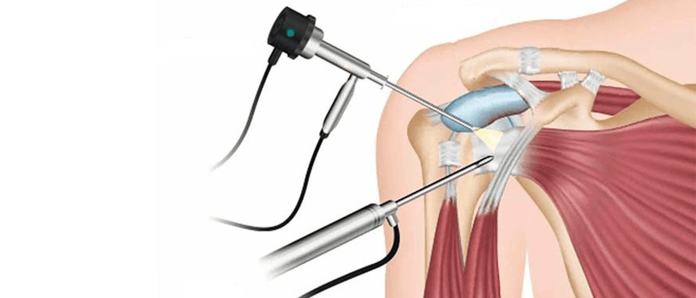 Shoulder Arthroscopy
